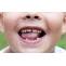 Orthodontic Solutions For Kids With Protruding Teeth