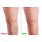 Best Varicose Veins Laser Treatment in Hyderabad | Dr. Abhilash