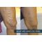 Varicose Veins Laser Treatment in Hyderabad | Varicose Veins