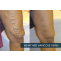 What are Varicose Veins? ,Symptoms, Causes &amp; Treatment, Procedures