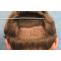 What happens when you get a FUE Hair Transplant? &#8211; Health Administrator
