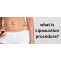 What is liposuction procedure and how does it reduce extra fat?