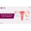 What Size Of Ovarian Cyst is Dangerous? Dr Ibrahim Elrahman