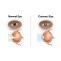 What is the Common Age to Get Cataracts?