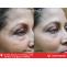 #1 Best Wrinkle Reduction Treatment in Durgapur