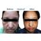 #1 Best Xanthelasma Removal Treatment in Durgapur